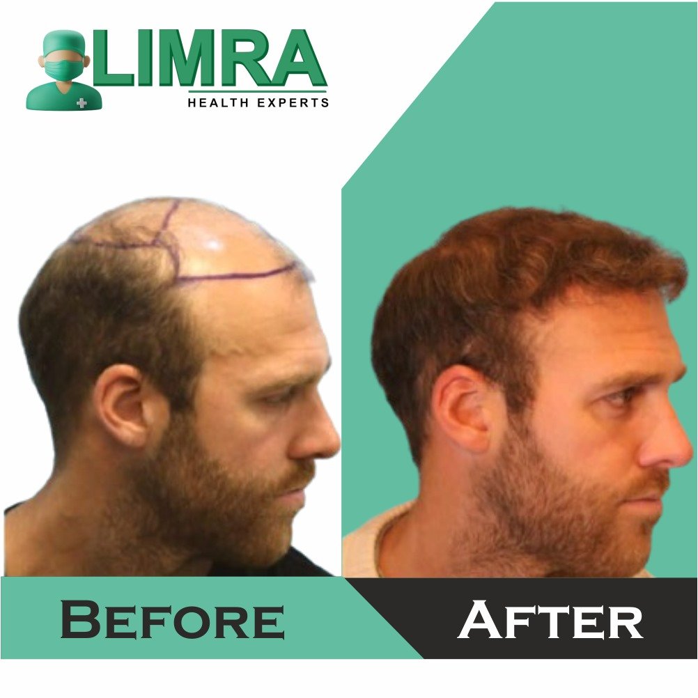 hair transplant in delhi